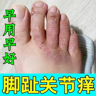 治脚趾关节痒起皮脚背发痒干燥脱皮掉皮屑脚指头皮肤痒草本修复膏
