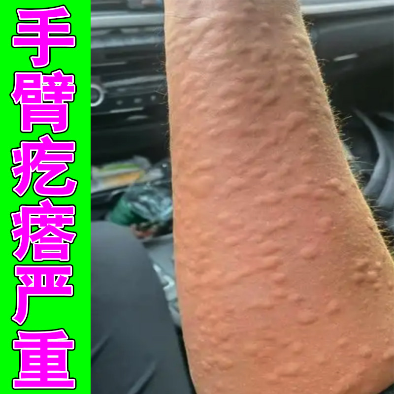 手臂长疙瘩痒皮肤过敏身上疙瘩严重红肿感染发痒专用草本修护乳膏