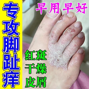 治脚趾关节痒脚背发痒干燥脱皮掉皮屑真菌感染皮肤溃烂草本修复膏
