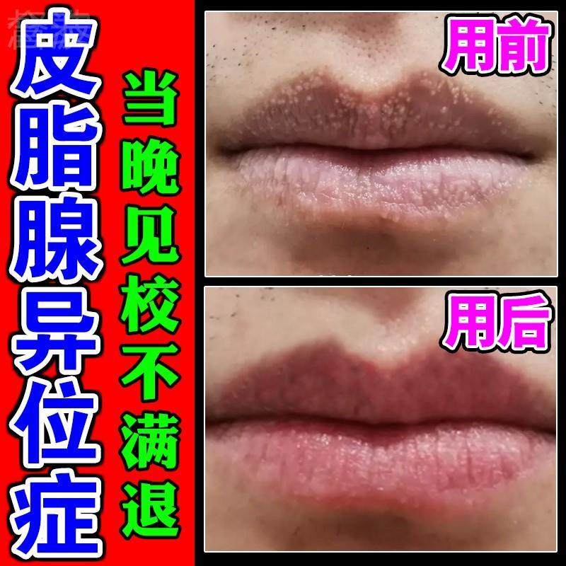 皮脂腺异位和鸡皮肤的区别(皮脂腺异位和鸡皮肤的区别是什么)