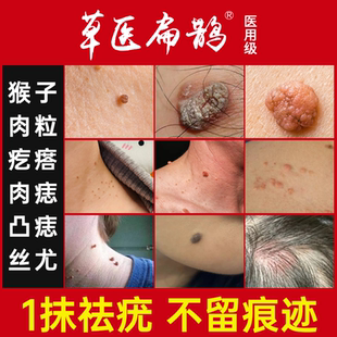 草医扁鹊医用级祛尤瘊长肉粒丝状疣祛疣型凝胶神器正非专官方旗舰