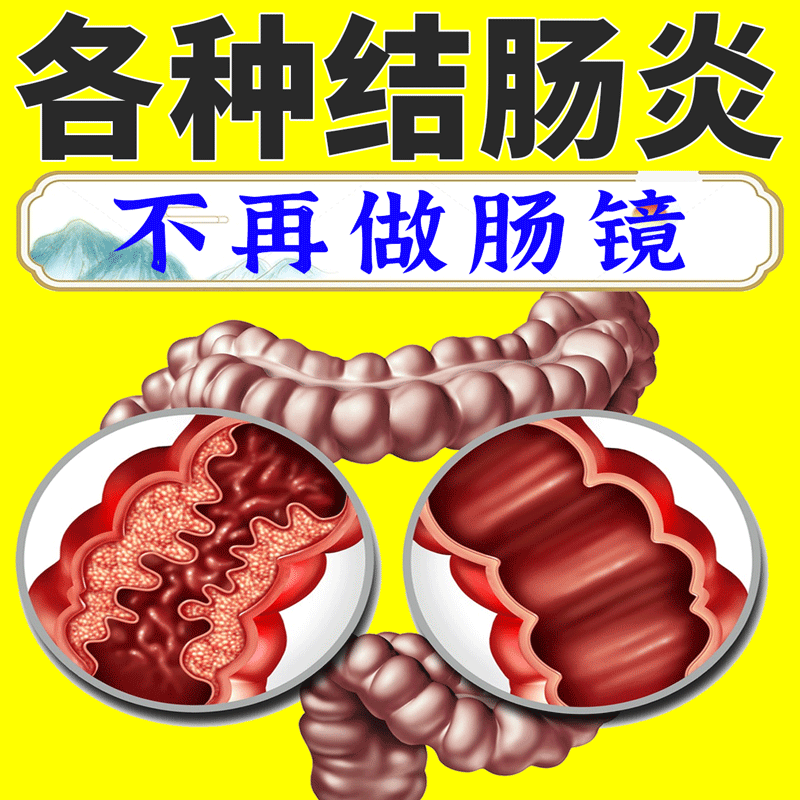 结肠炎肚脐贴慢性溃疡性拉肚子止泻调理腹痛大便不成形