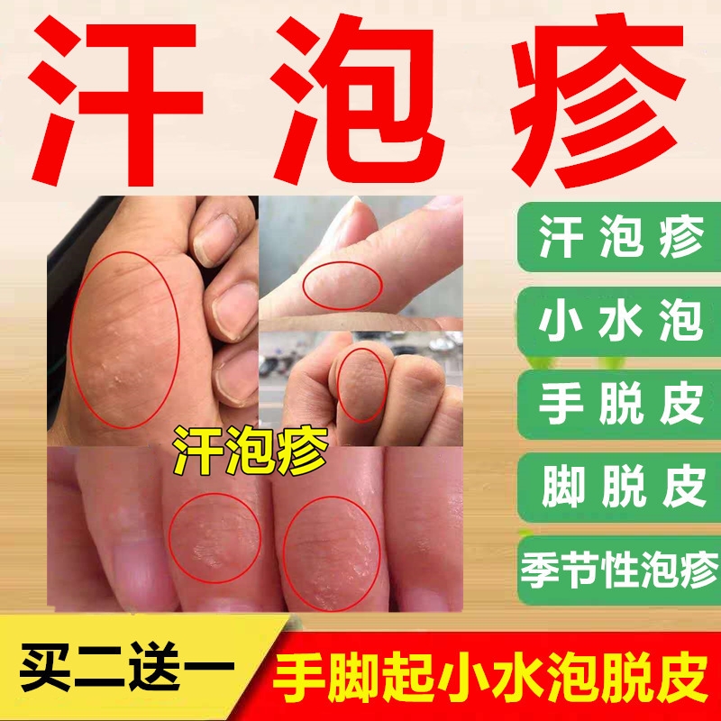 汗疱疹手上起小水泡手脚瘙痒脱皮干裂手股藓油手指