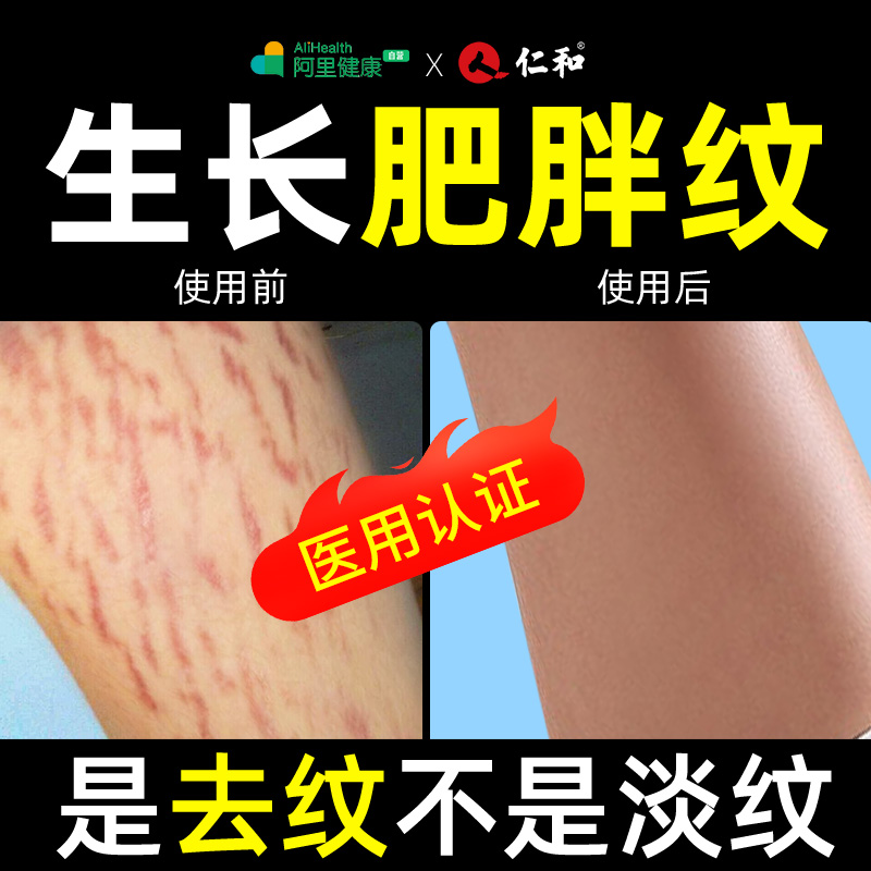 直击生长纹肥胖纹！去纹专用