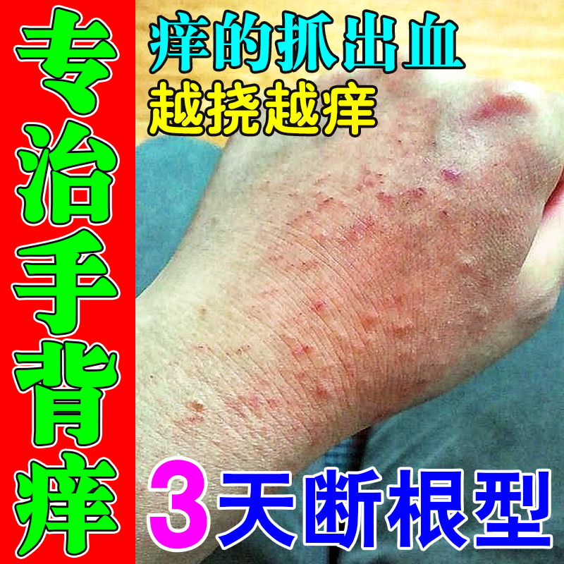 手背痒日光性皮炎手背癣抑菌药膏