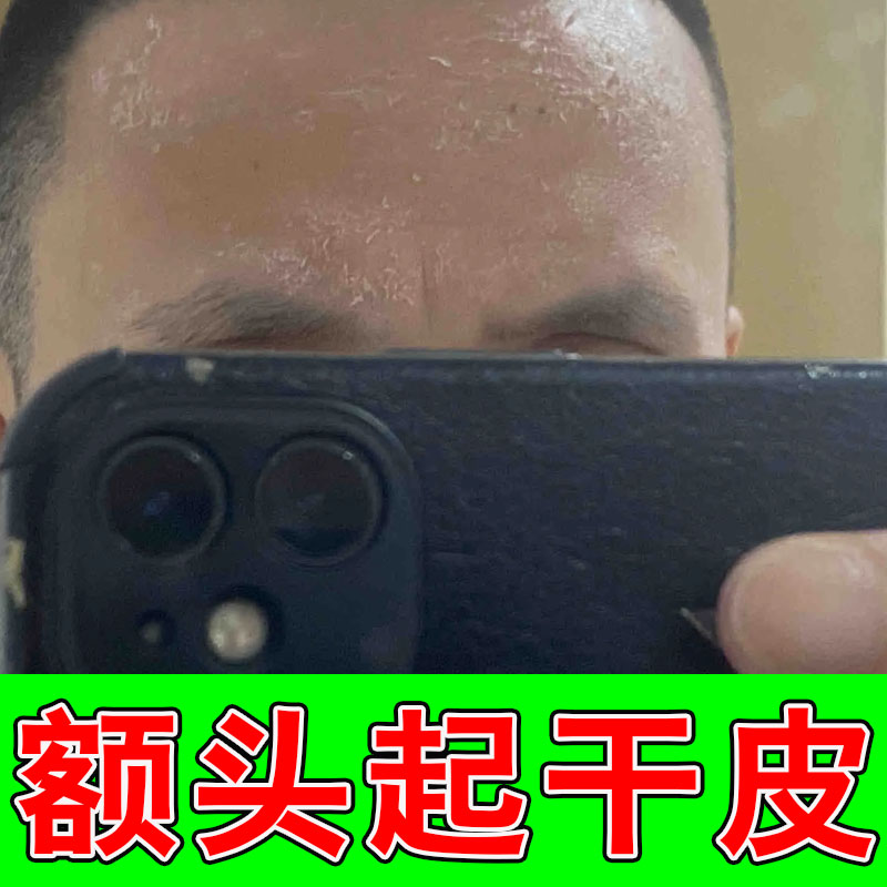 脸缺水干燥起皮鼻翼嘴角有碎屑皮肤痒掉皮修复滋润护肤油