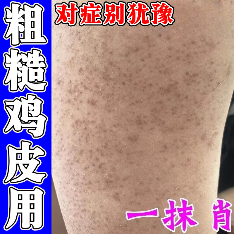 胳膊皮肤疙瘩鸡皮毛囊角化膏去腿上上粗糙小颗粒黑点毛周角质症