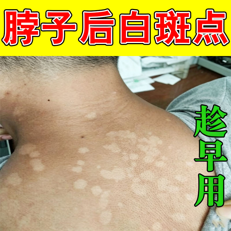 脖子后汗斑花斑专用手臂长小白点褐色斑块消白斑皮肤痒软膏