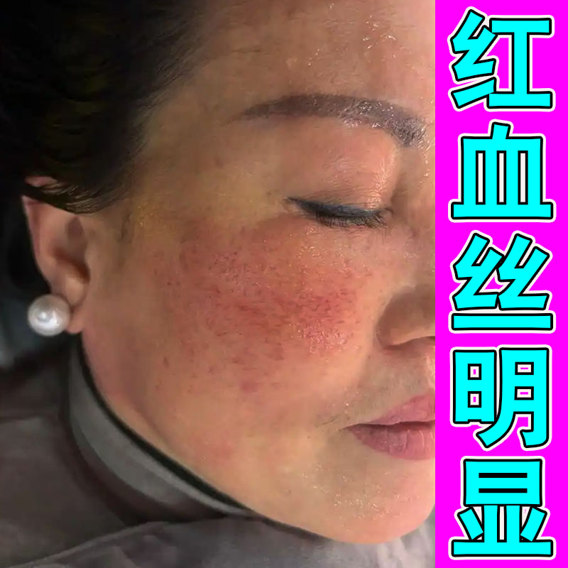 去脸上的红血丝增加皮肤角质层薄皮肤消毒护理（消）