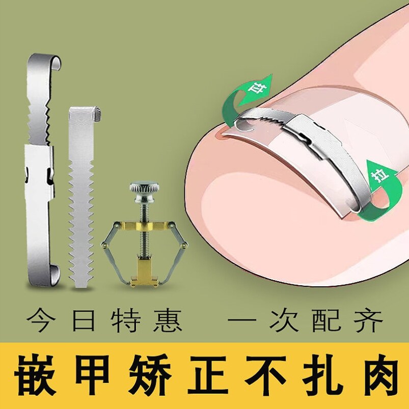 指甲往肉里长专用正甲扣大脚趾甲沟嵌甲矫正器家用护理炎贴片神器