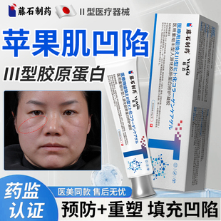 苹果肌胶原蛋白填充面部凹陷法令纹泪沟脸颊凹陷神器三型下垂KD