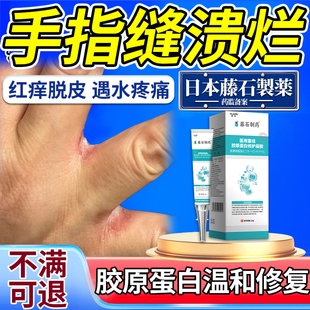 藤石制药碰水手指缝溃烂膏痒水泡干裂脱皮开裂口疼痛烂手丫糜烂KD
