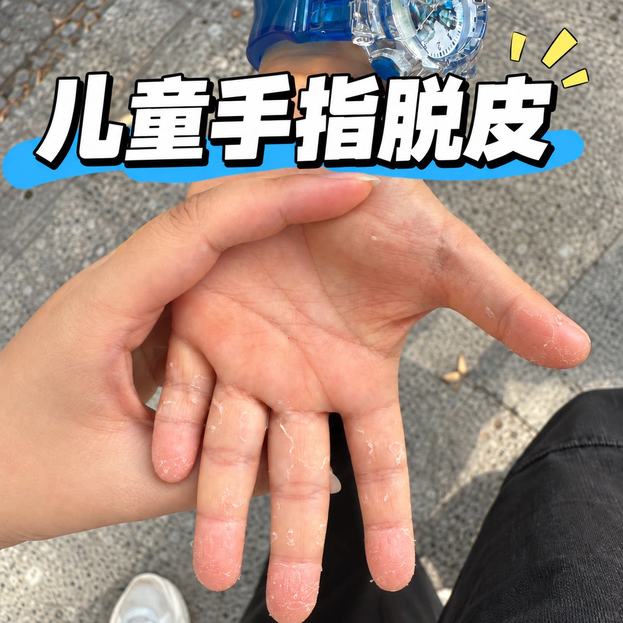 儿童手指脱皮小孩手严重专用真菌蜕皮干燥起皮剥脱性角质松懈症KD