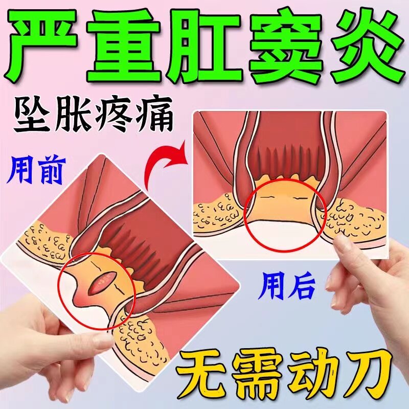 治疗肛窦炎肛门坠胀排便困难疼痛出血直肠脱垂出瘙痒周松弛乳膏药