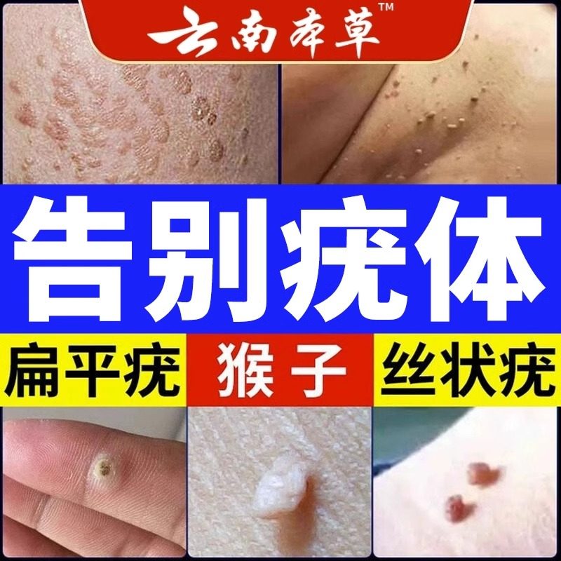 云南本草脖子丝状尤扁平尤小点克尤清软膏五氟尿嘧啶祛尤必净克优