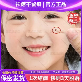 点痣药水不留疤拾痦子药膏老古方去痣药膏工具膏官方正品国家标准
