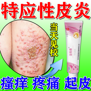 儿童特应性皮炎止痒抑菌特异性宝宝湿疹软膏去身体乳根皮肤瘙痒用