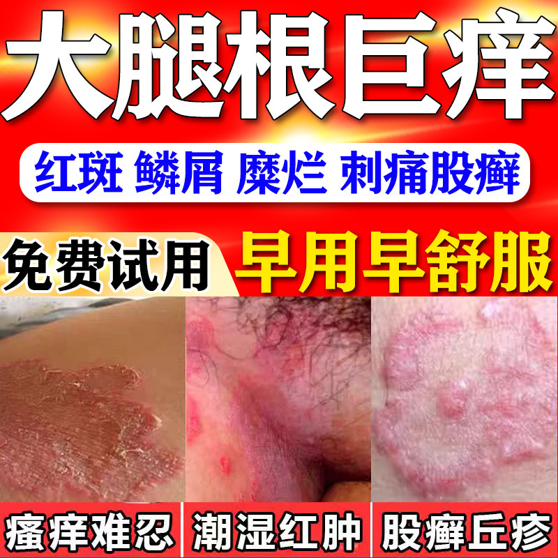 大腿内侧皮肤瘙痒股藓两侧红斑长疙瘩否止痒根去私处红疹真菌感染