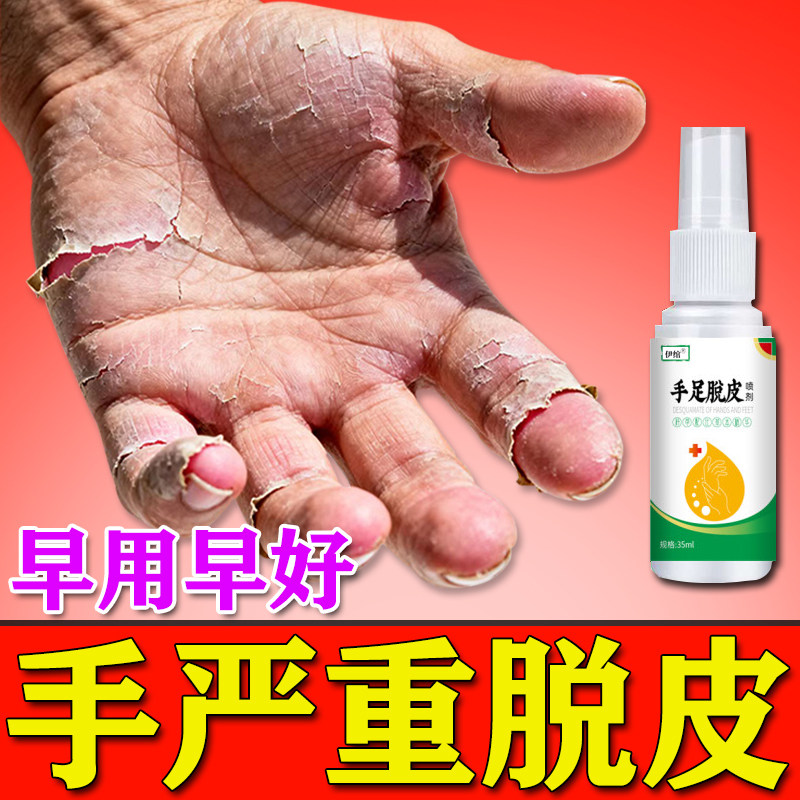 手脱皮药膏真菌感染喷剂