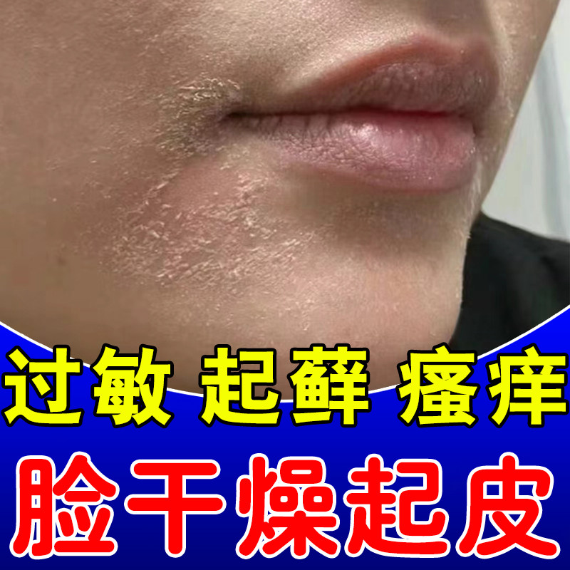 过敏皮肤修复脸部医用痒红肿干燥起皮脸上泛红血丝敏感肌晒伤痒Z