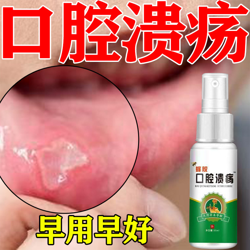 【早用早好】蜂胶口腔溃疡修复液