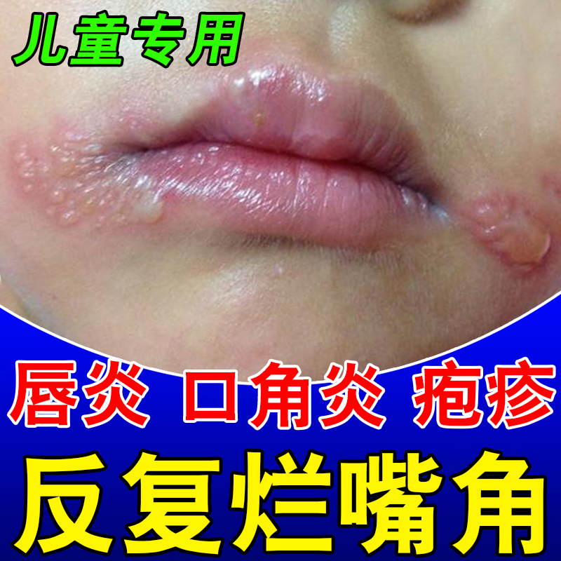 唇炎专唇膏嘴唇干裂脱皮烂嘴角开裂口角炎儿童嘴巴干燥起皮药用Z