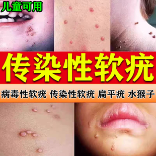 【传染性软疣】儿童病毒性水猴子软尤肉粒一抹无忧成人去除神器膏
