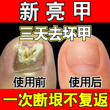 正品新亮甲灰指甲阿莫罗芬搽剂旗舰店脱甲液脱甲油净专用药房官方