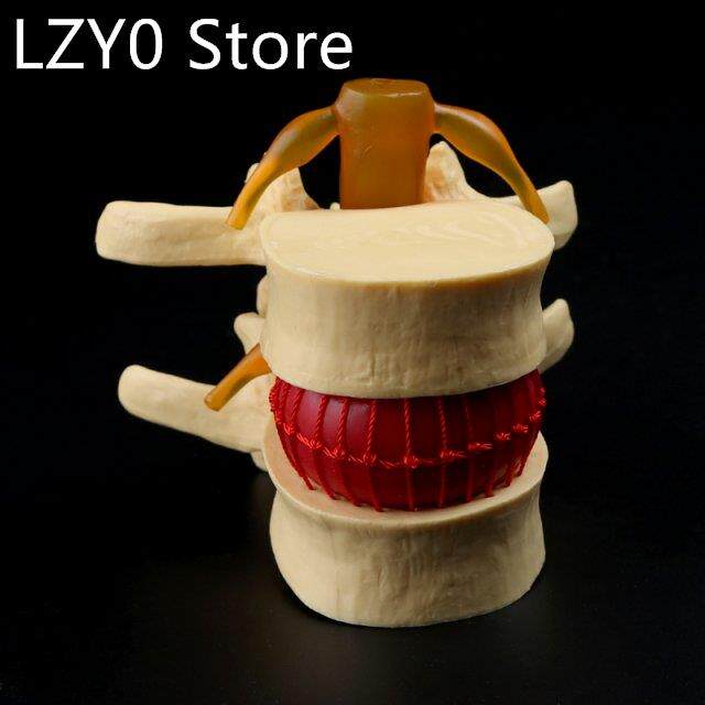 anatomical spine lumbar disc herniation anatomy medical teac
