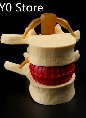 Anatomical Spine Lumbar Disc Herniation Anatomy Medical Teac