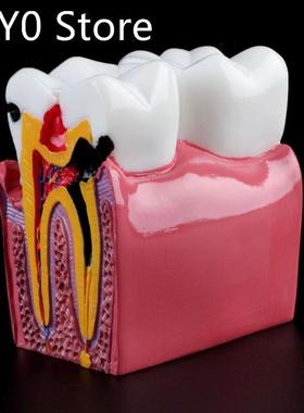 6 Times Dental Caries Comparation Anatomy Teeth Model for De