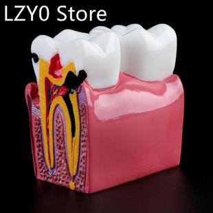 6 Times Dental Caries Comparation Anatomy Teeth Model for De