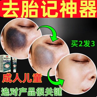 胎记去除神器祛除天生胎记太田痣咖啡斑儿童成人脸部黑色素淡化膏