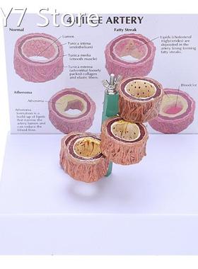Atherosclerosis Thrombosis Model Vascular Disease Demonstrat