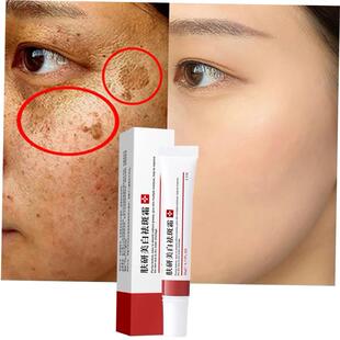 Whitening Freckle Cream Remove Melasma Cream Remove Dark Spo
