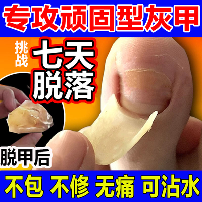 灰指甲特药水专用凤仙花抑菌液亮甲真菌感染增厚脱甲膏效正品神器