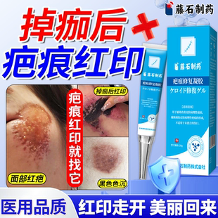擦伤摔伤疤痕修复除疤膏去红印黑色素沉淀医用疤痕软膏儿童小孩QN