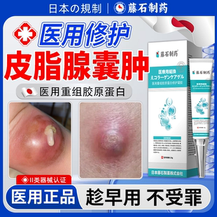 皮脂腺囊肿拔毒拔脓膏火疖子硬块粉瘤消瘤膏搭药膏凝胶专针贴用QN