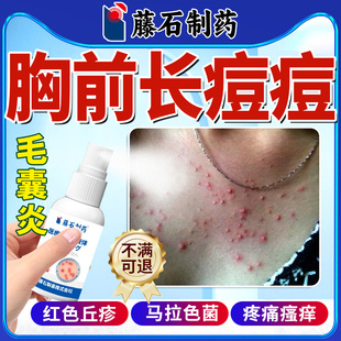 毛囊炎前胸后背胸前长痘痘喷雾剂胸口硬疙瘩马拉色菌除螨祛痘痒QN