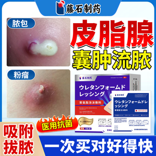 皮脂腺囊肿火疖子拔毒拔脓膏敷料贴粉瘤硬块消瘤专用膏药贴JQ