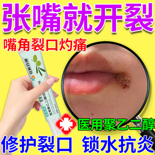 嘴角开裂口角炎烂嘴角干燥起皮儿童口周皮炎溃疡疱疹可搭药膏QN
