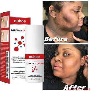 Dark Spot Remover Cream Whitening Body Lotion Lighten Melani