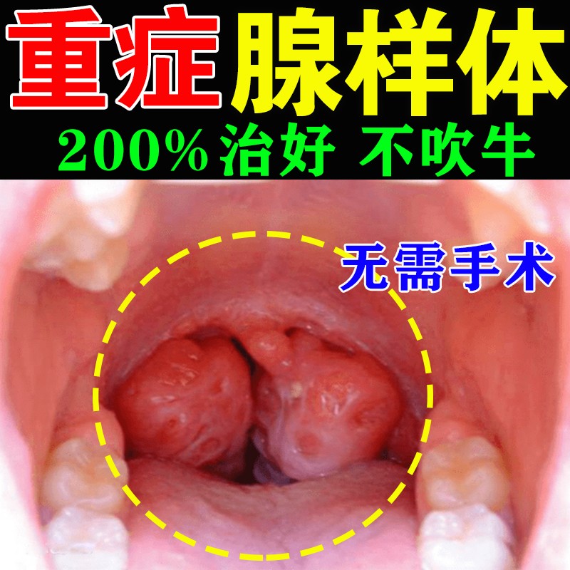 腺样体肥大中药贴治疗儿童鼻塞张嘴呼吸不通气调理面容矫正器gh