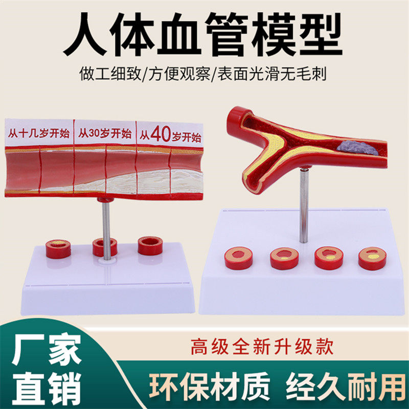堵塞心血管模型关节血栓血液浓度脂肪病理粥样硬化人体解剖教具