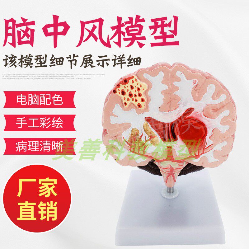 人体脑解剖模型 脑中风 脑出血 动脉瘤 大脑动静脉畸形脑病理模型