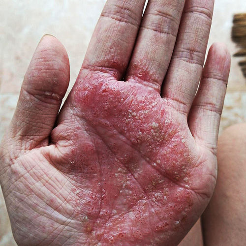 掌跖脓包病治疗手脚脓包干裂