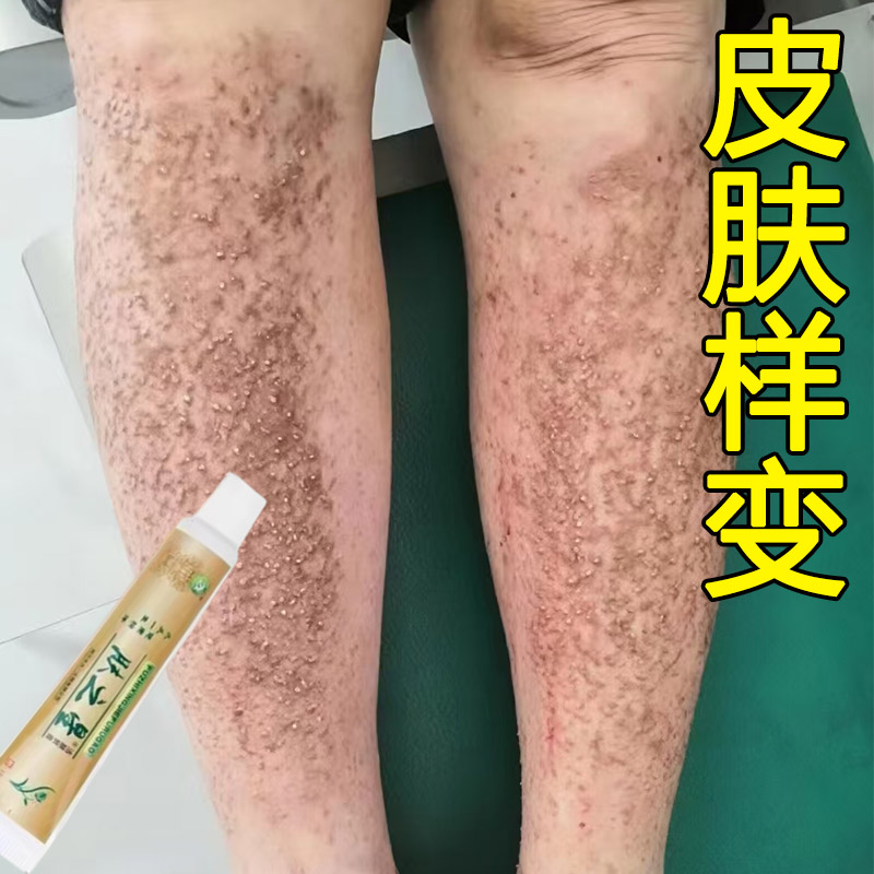 皮肤淀粉样变黑色沉淀顽固胳膊小腿皮肤粗糙颗粒痒皮藓止痒药膏