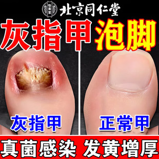 北京同仁堂灰指甲泡脚药包真菌感染脚气脱皮止痒杀菌治疗中药水