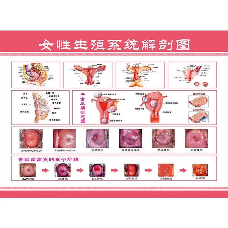 新性生殖系统解刨图海报宫颈疾病示意图解剖子r宫妇科挂画宣传画