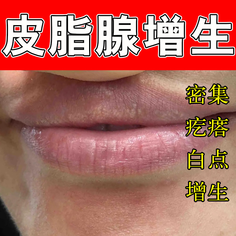 嘴唇皮脂腺异位唇部白点脂肪小颗粒脂肪粒白点增生颗粒疙瘩白点膏